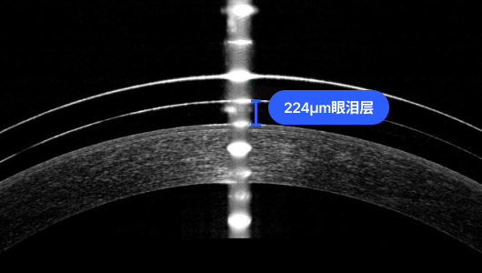 원추각막 특수 렌즈 이미지