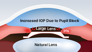 큰 렌즈를 삽입할 경우 